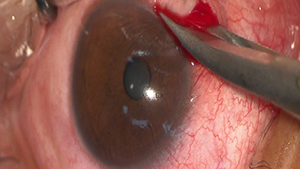 深层角膜及前房板栗刺异物取出