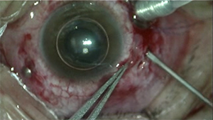 折叠式人工玻璃体植入术