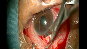 穿透性黏小管成形术治疗原发性闭角型青光眼