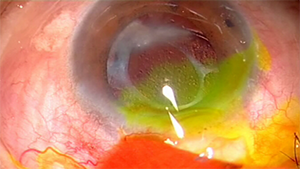 利用自体Tenon修补滤过泡渗漏手术