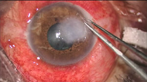 以生物工程角膜为供体的板层角膜移植术