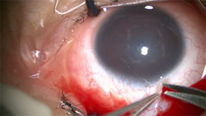 角膜后弹力膜剥除自动角膜刀取材内皮移植术