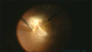 钝性膜分离法在复杂增生性糖尿病视网膜病变手术中的应用