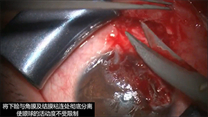 睑球粘连分离联合结膜和羊膜移植手术