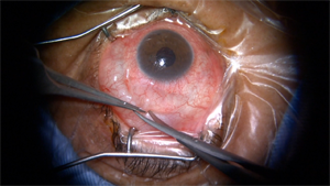 青光眼引流阀植入术