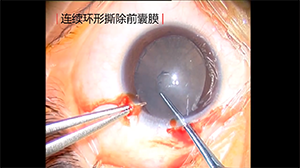 连续环形后囊撕除联合人工晶状体光学部夹持术