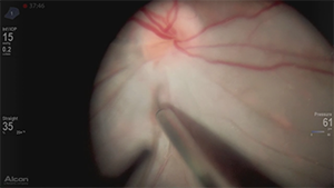 视网膜静脉插管术治疗半侧视网膜中央动脉阻塞