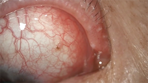 结膜羊狂蝇幼虫