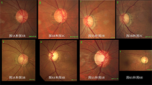眼底图像配准检测青光眼视神经损伤变化