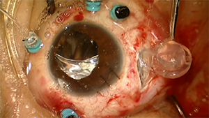 人工玻璃体球囊植入手术治疗眼球痨