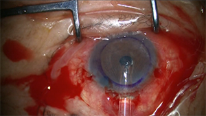 DMEK术中展开植片