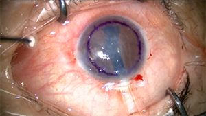 DMEK术中翻转植片