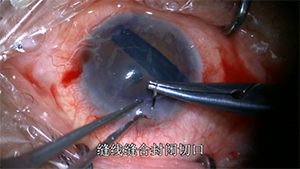 玻璃体切除术后硅油残留眼的角膜后弹力层内皮移植术