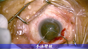KDB小梁切除联合白内障超声乳化吸除术
