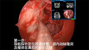 导航引导下鼻内镜经蝶筛入路摘除眶尖部海绵状血管瘤