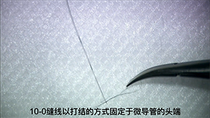 微创内路三联手术治疗开角型青光眼